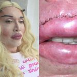 Pete Burns lip surgery 33