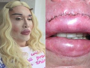 Pete Burns lip surgery 33