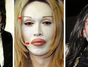 Pete Burns plastic surgery 35