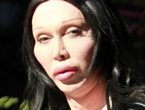 Pete Burns plastic surgery 37