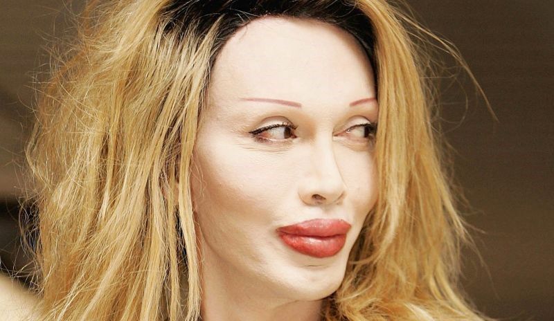 Pete Burns plastic surgery