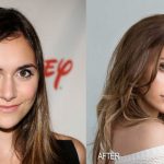 Alyson Stoner before and after plastic surgery
