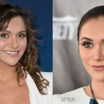 Alyson Stoner before and after plastic surgery 2