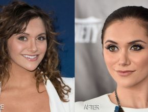 Alyson Stoner before and after plastic surgery 2