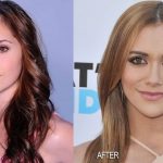 Alyson Stoner before and after plastic surgery 3