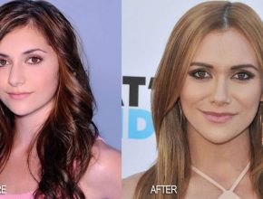 Alyson Stoner before and after plastic surgery 3