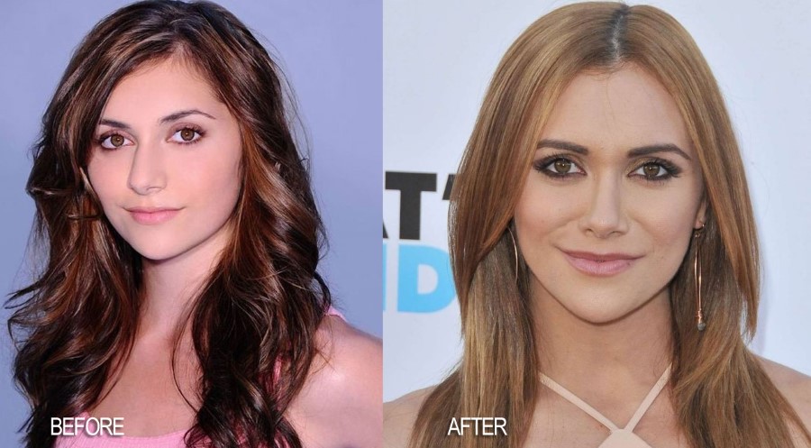Alyson Stoner before an after plastic surgery