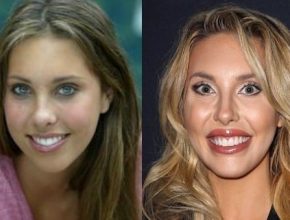 Chloe Lattanzi before and after plastic surgery