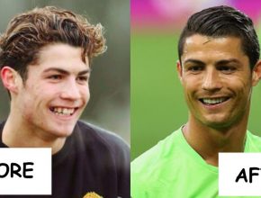 Cristiano Ronaldo before and after plastic surgery