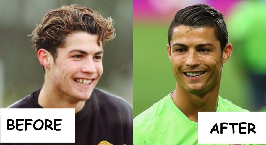 Cristiano Ronaldo before and after plastic surgery
