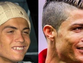 Cristiano Ronaldo plastic surgery 27