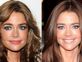 Denise Richards before and after plastic surgery 1