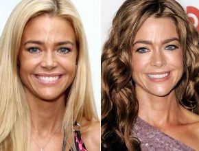 Denise Richards before and after plastic surgery