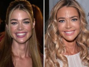 Denise Richards before and after plastic surgery 40