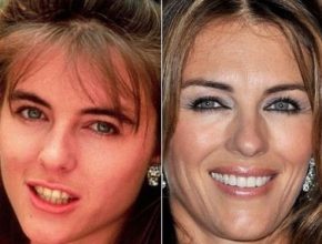 Elizabeth Hurley before and after plastic surgery