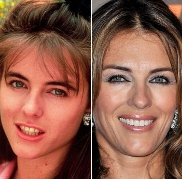 Elizabeth Hurley before and after plastic surgery