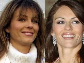 Elizabeth Hurley before and after plastic surgery 16