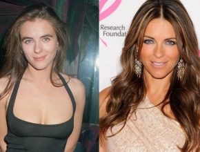Elizabeth Hurley before and after plastic surgery 27