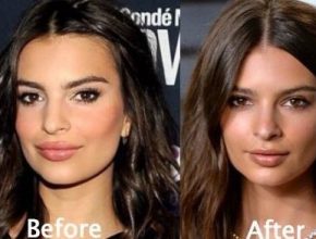 Emily Ratajkowski before and after plastic surgery