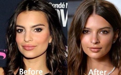 Emily Ratajkowski before and after plastic surgery