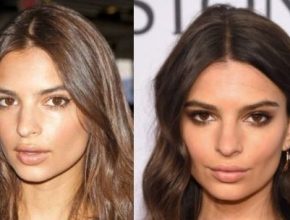 Emily Ratajkowski before and after plastic surgery 12