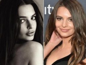 Emily Ratajkowski before and after plastic surgery 01