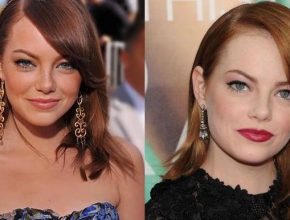 Emma Stone before and after plastic surgery 2