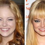 Emma Stone before and after plastic surgery 26