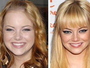 Emma Stone before and after plastic surgery 26