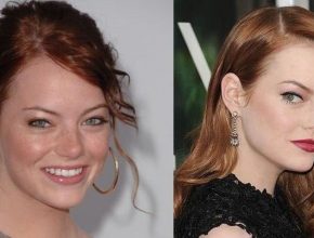 Emma Stone before and after plastic surgery