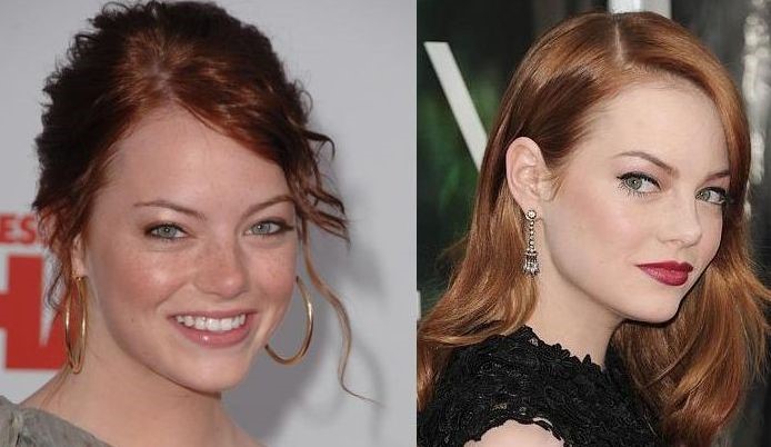 Emma Stone before and after plastic surgery.