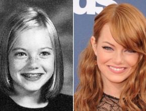 Emma Stone before and after plastic surgery 6