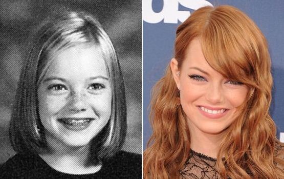 Emma Stone before and after plastic surgery 6.