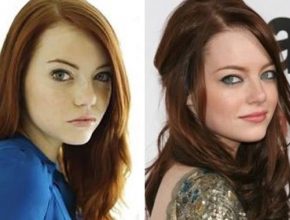 Emma Stone before and after plastic surgery 8