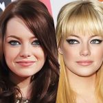 Emma Stone before and after plastic surgery 9