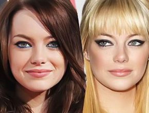 Emma Stone before and after plastic surgery 9
