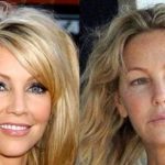 Heather Locklear before and after plastic surgery 3