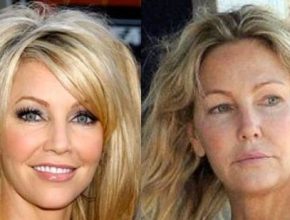 Heather Locklear before and after plastic surgery 3