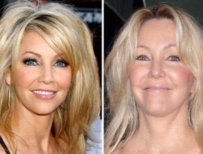 Heather Locklear before and after plastic surgery