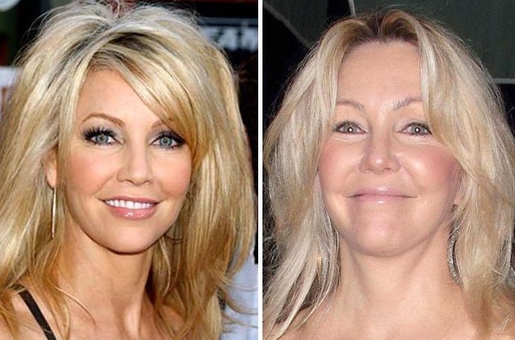 Heather Locklear before and after plastic surgery