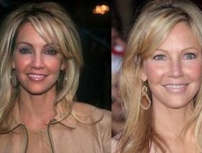 Heather Locklear before and after plastic surgery 7