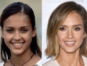 Jessica Alba before and after plastic surgery