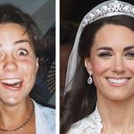 Kate Middleton before and after plastic surgery 1