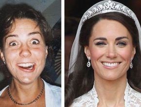 Kate Middleton before and after plastic surgery 1