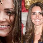 Kate Middleton before and after plastic surgery 13
