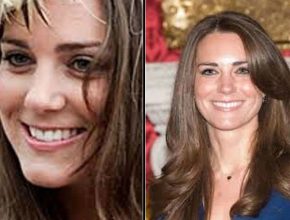 Kate Middleton before and after plastic surgery 13