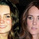 Kate Middleton before and after plastic surgery 15