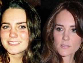 Kate Middleton before and after plastic surgery 15