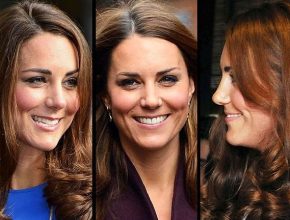 Kate Middleton before and after plastic surgery 2