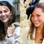 Kate Middleton before and after plastic surgery 4